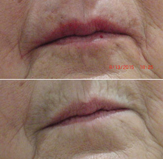 dermal filler results 4