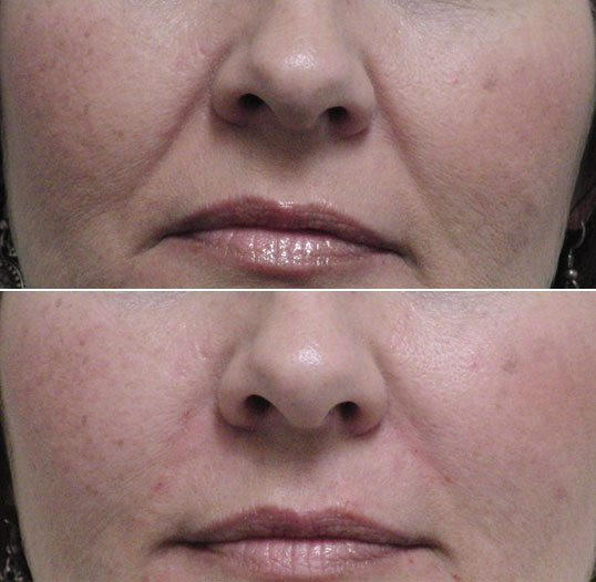 dermal filler results 7