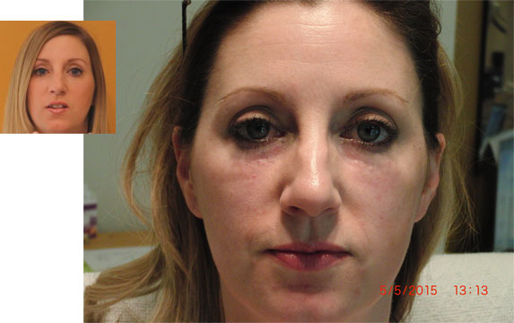 dermal filler results 1