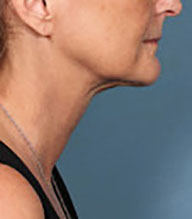 After kybella treatment