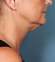 Before kybella treatment