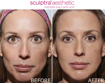 Sculptra results 3