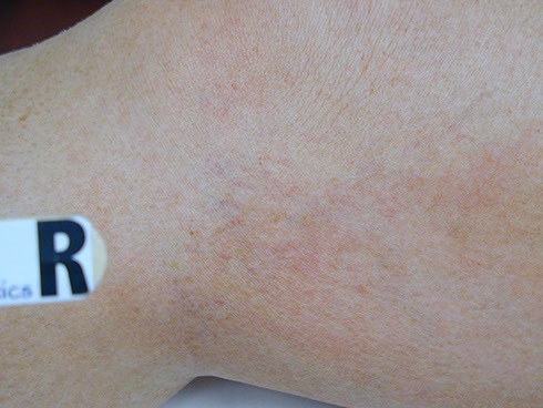 after sclerotherapy 2