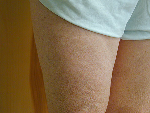 after sclerotherapy 3