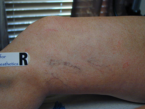 before sclerotherapy 2