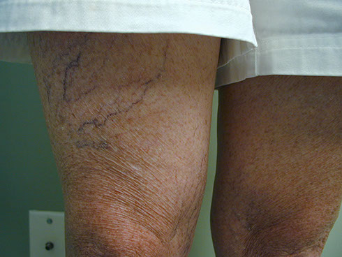 before sclerotherapy 3