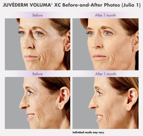 Juvederm Voluma XC before and after results